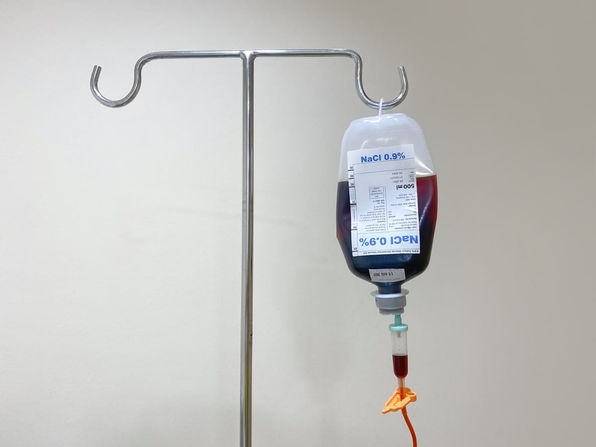 A close-up view of an IV bag with iron infusion solution, highlighting the medical equipment used for iron supplementation.