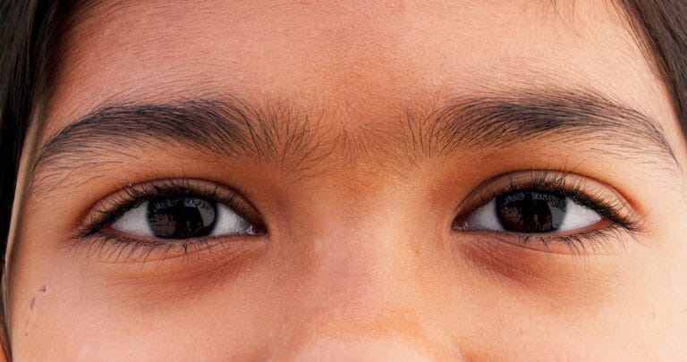 A close-up of a child's eyes with natural eyebrows, highlighting the effects of iron deficiency on vision health.